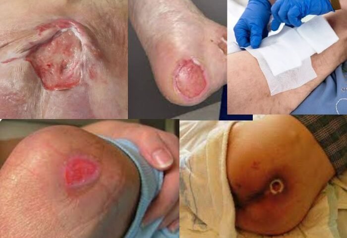 Infirmier soins d escarres à domicile Rabat Salé Témara au Maroc