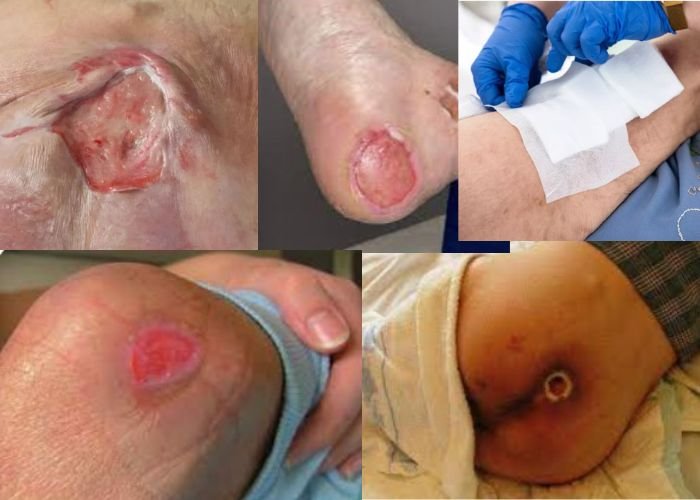 Infirmier soins d escarres à domicile Rabat Salé Témara au Maroc