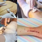 Service infirmier changement de pansement post opératoire Rabat Salé Témara au Maroc